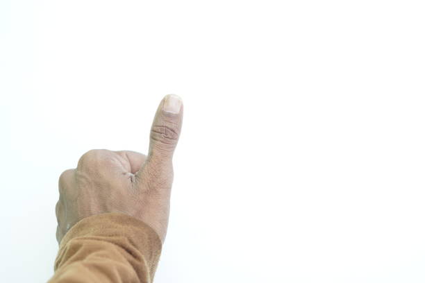 thumb nail psoriasis ,close up view