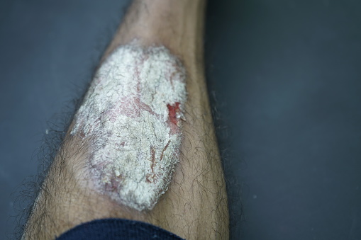 Psorisis wound on lower leg