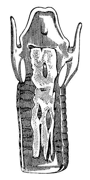 Medical illustration of a human larynx with a pseudomembrane from a patient suffering from diphtheria croup (laryngotracheobronchitis). Vintage etching circa 19th century.