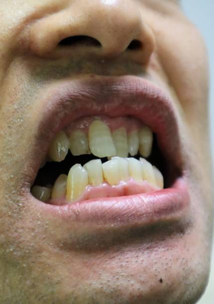 istock Person with bad teeth 1634129445