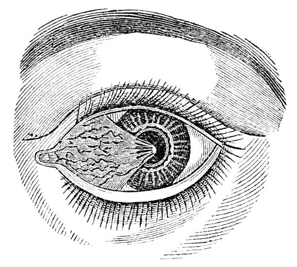 istock Medical Illustration of a Human Eye with Pterygium (Surfer’s Eye) - 19th Century 1634134796