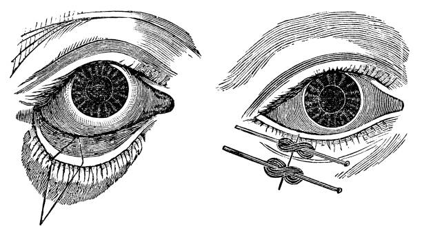 istock Medical Illustration of Involutional Ectropion Repair Surgery on a Human Eye with Ectropion - 19th Century 1634138485