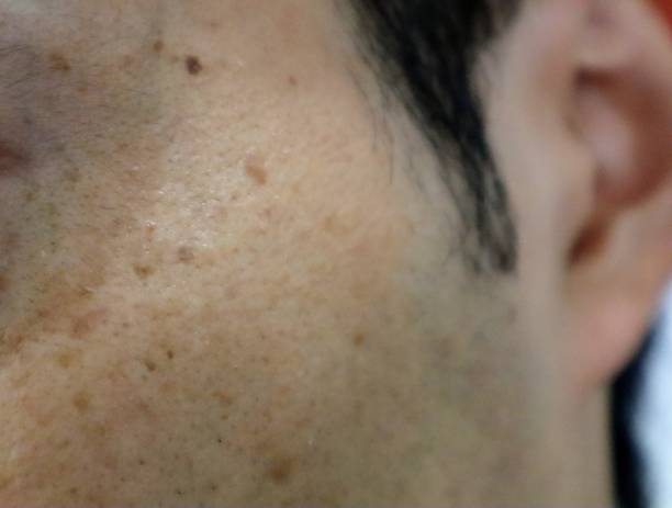 istock Close up of spots on Japanese man's face 1634141470