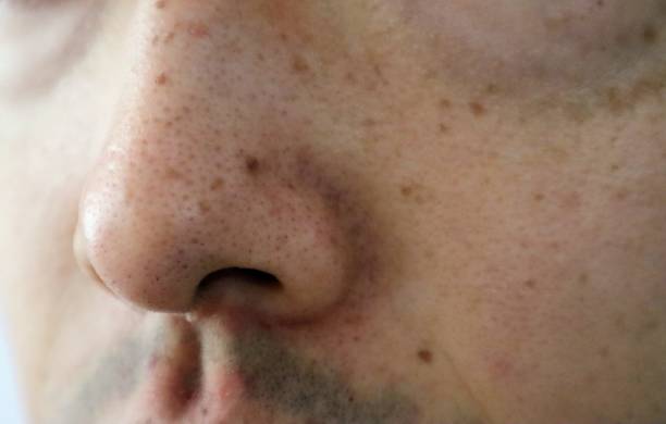istock Close up of spots on Japanese man's face 1634143992