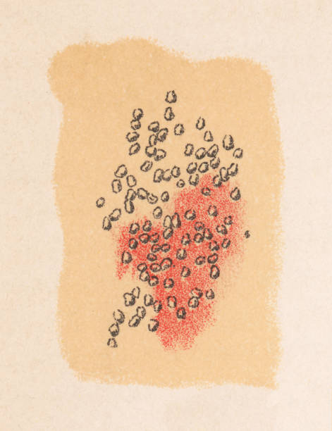 Medical illustration of human skin with atopic dermatitis (eczema). Vintage etching circa 19th century.