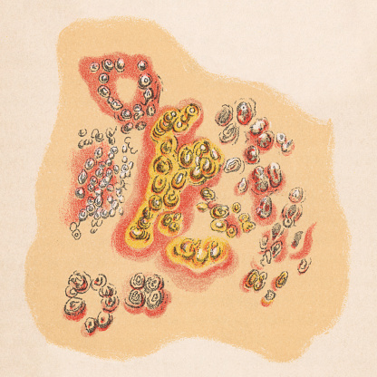 Medical illustration of human skin with various different blisters and rash from the herpes simplex virus. Vintage etching circa 19th century.
