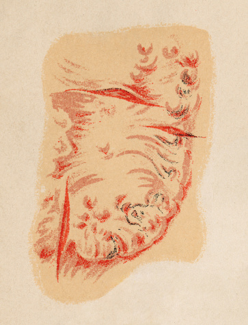 Medical illustration of human skin with leprosy (Hansen's disease). Vintage etching circa 19th century.