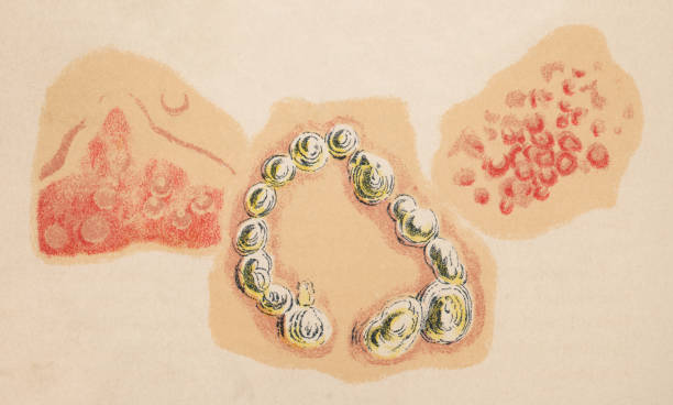Medical Illustration of Human Skin with Uticaria (Hives), Pemphigus and Erythema Nodosum - 19th Century Medical illustration of human skin with uticaria (hives) [left], pemphigus [middle], and erythema nodosum [right]. Vintage etching circa 19th century. erythema nodosum stock illustrations