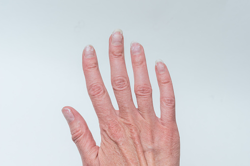 Close-up of a woman's age-old hand with wrinkles with natural nails, overgrown cuticle on a white background. Crooked fingers, gout. A hand with age-related changes. The concept of natural nails