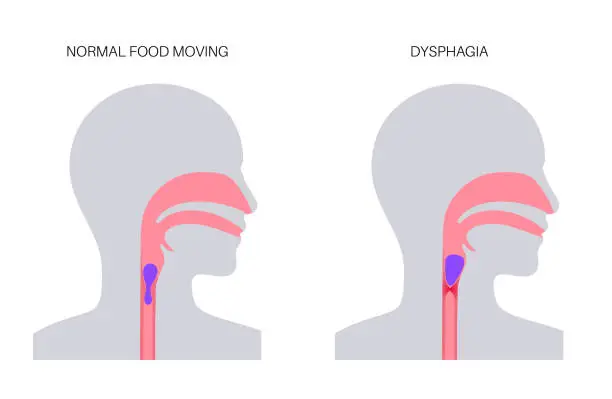 Vector illustration of Dysphagia medical poster