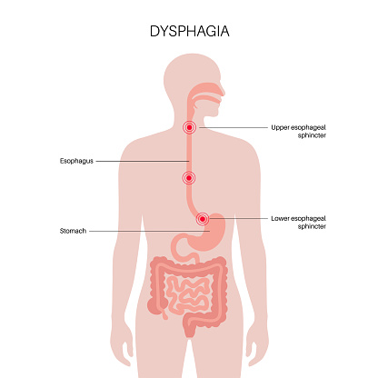 Dysphagia medical poster. Difficult or painful swallowing. Esophagus disease concept. Difficulty in the passage of solids or liquids from the mouth to the stomach. Digestive tract problem flat vector