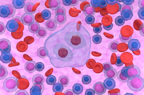 cellule de reed-sternberg dans le lymphome hodgkinien - illustration de rendu 3d vue de face - hodgkins disease photos et images de collection