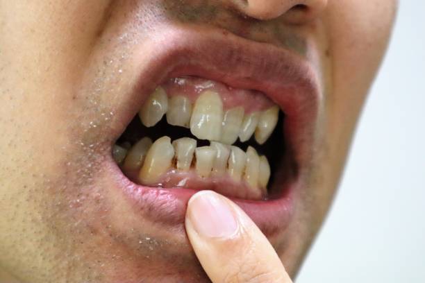 istock Person pointing to unsanitary teeth 1636115533