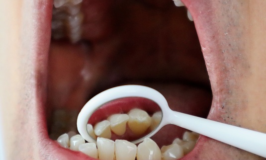 Photo of person examining teeth