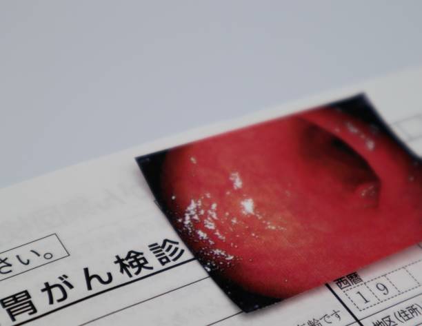 istock Image of stomach cancer screening in Japan 1636360195