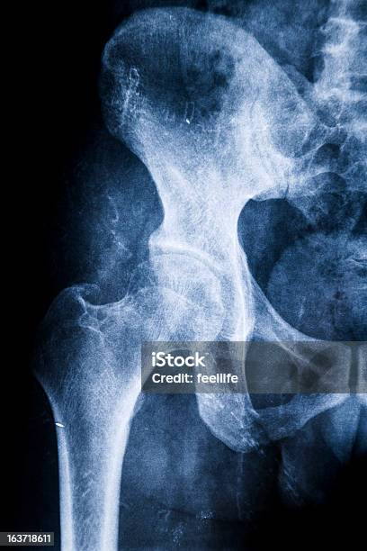 Photo libre de droit de Hanche Droite Xray Hip Xray Fankylosing Ankylosante Dans Une Articulation Sacroiliaque banque d'images et plus d'images libres de droit de Cuisse - Jambe humaine