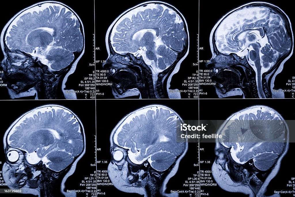 Bébé cerveau Scanner à résonance magnétique :  leukodystrophy anomalie maladie et axé sur le développement - Photo de Image par résonance magnétique libre de droits