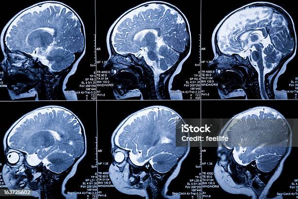 Photo libre de droit de Bébé Cerveau Scanner À Résonance Magnétique Leukodystrophy Anomalie Maladie Et Axé Sur Le Développement banque d'images et plus d'images libres de droit de Image par résonance magnétique