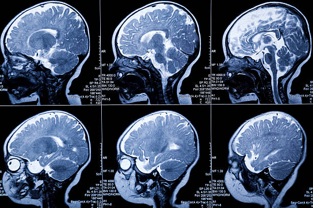 아기 MRI는 뇌 스캔: leukodystrophy 질병 및 발달 이상 스톡 사진