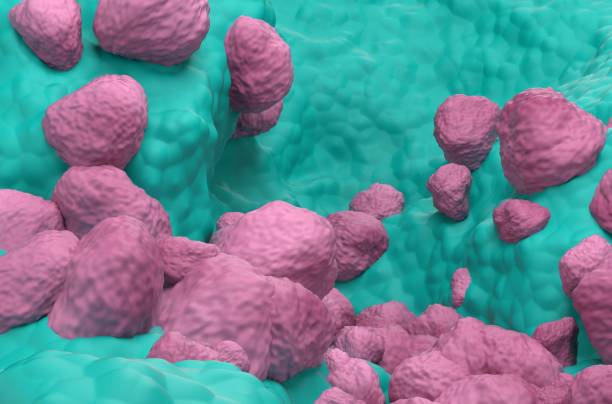 istock Non Small Cell Lung Cancer (NSCLC) in the lung tissue  closeup view 3d illustration 1637353938