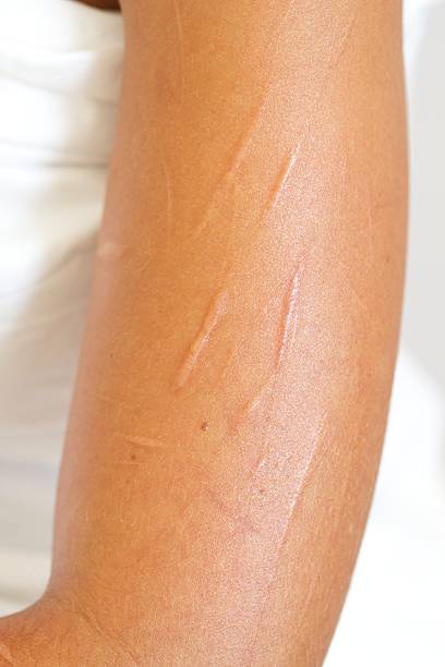 Badly Scarred Upper Arm from Self Mutilation by Cutting White girl with badly scarred upper arm from self mutilating through cutting. self harm photos stock pictures, royalty-free photos & images