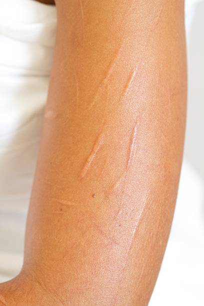 Badly Scarred Upper Arm from Self Mutilation by Cutting White girl with badly scarred upper arm from self mutilating through cutting. self mutilation pictures stock pictures, royalty-free photos & images