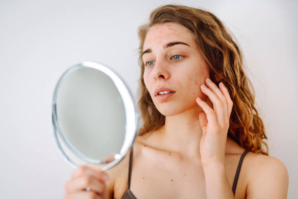 istock Beautiful woman with problematic skin looks in her small mirror. 1637600958
