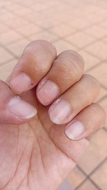 istock woman's hands with bad cuticles. nail care concept 1637663679