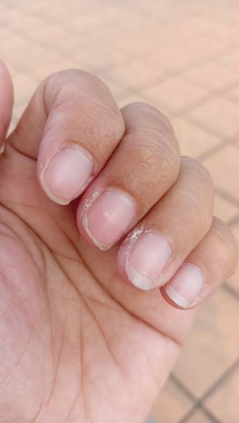 istock woman's hands with dry skin and hanging nails. Nails with bad cuticles. 1637664189