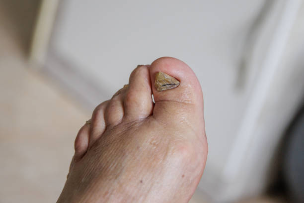 grzyb paznokci. problem porodu w paznokciach - candida zdjęcia i obrazy z banku zdjęć