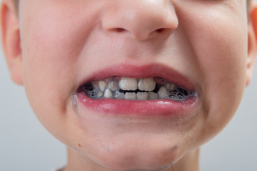 Cute smile of a 7-year-old boy without one baby tooth who brushed his teeth with black toothpaste on a light background