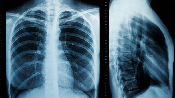 istock Frontal and lateral projections of a female chest x-ray 1639456898