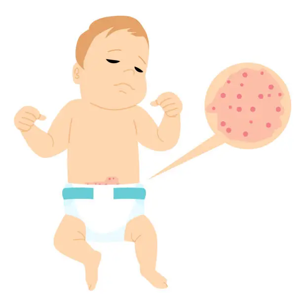 Vector illustration of Baby With Diaper Rash Allergic Itching