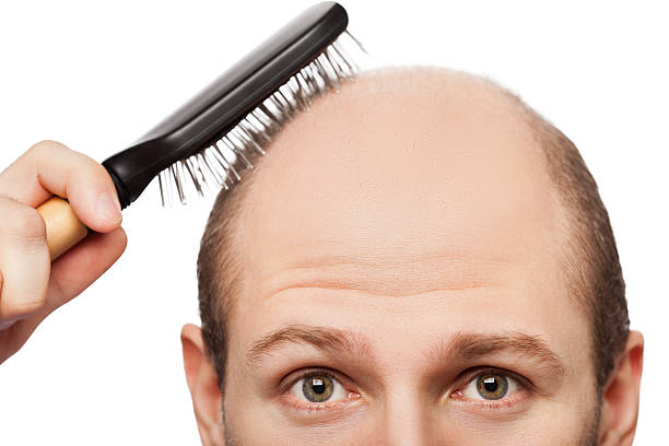 Bald man attempting to use hairbrush Human alopecia or hair loss - adult man hand holding comb on bald head completely bald stock pictures, royalty-free photos & images