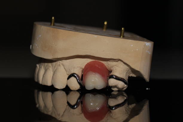 istock dental technician model removable prosthesis PAPM cobalt chrome resin wax tooth denture frame 1640289134