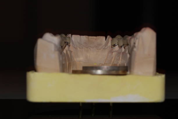 istock dental technician model fixed prosthesis ceramic wax up plaster crown ceramo ceramic CCM 1640294359