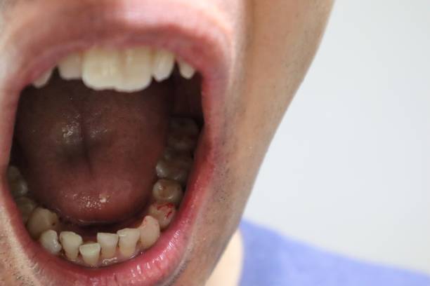 istock Japanese man immediately after treatment for tooth decay 1640394607