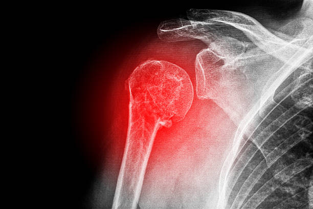 fraturei braço - x ray x ray image shoulder human arm - fotografias e filmes do acervo