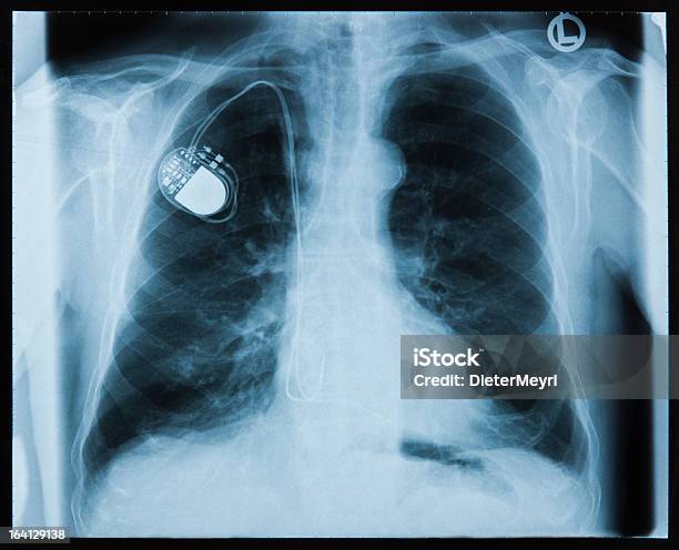 Xrayed Do Peito - Fotografias de stock e mais imagens de Estimulador Cardíaco - Estimulador Cardíaco, Cuidados de Saúde e Medicina, Dados