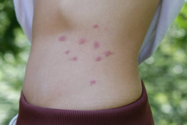 Red, swollen and itchy spots on skin caused by insect bites or allergy. Skin reaction to insect bites. stock photo