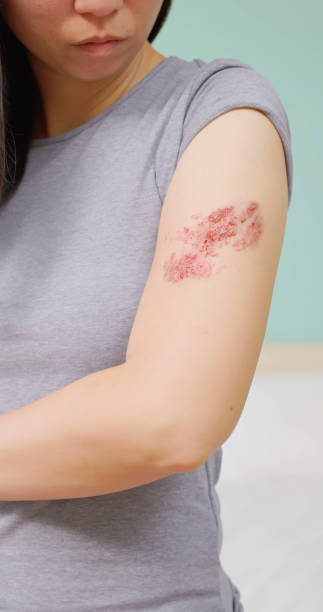 istock Painful shingles in woman 1642348367