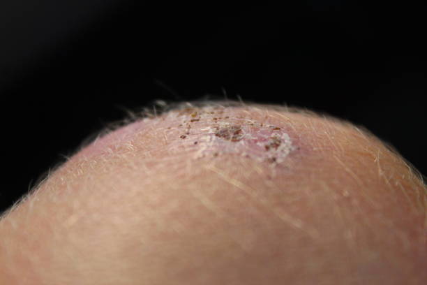 A scab on the top of someone's knee A photo of a scab on the knee of someone. eschar stock pictures, royalty-free photos & images
