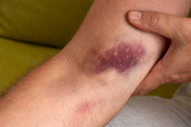 istock Male hand with a large hematoma. 1642569435