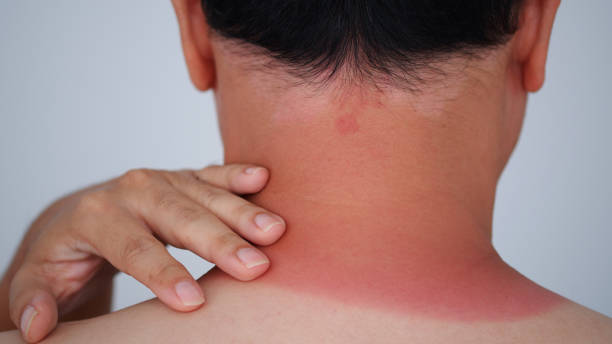 istock Redness on the man neck of sunburn. 1643316739