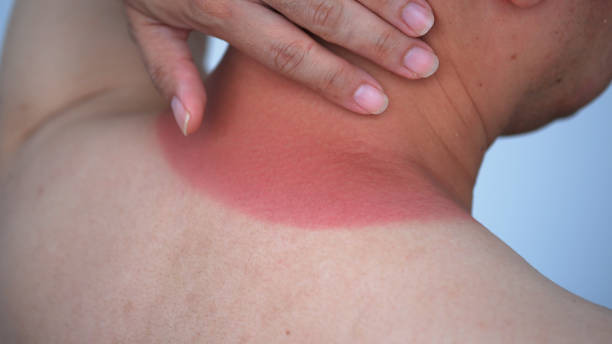 istock Redness on the man neck of sunburn. 1643317158