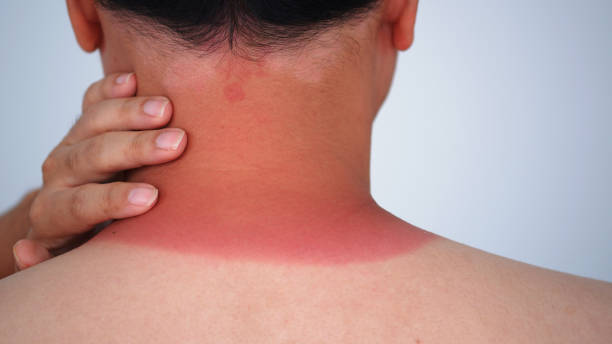 Redness on the man neck of sunburn.