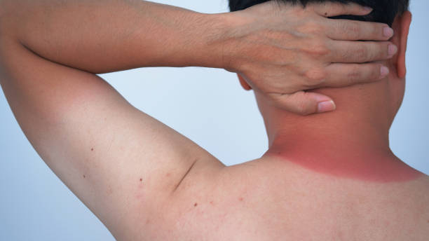 istock Redness on the man neck of sunburn. 1643317799