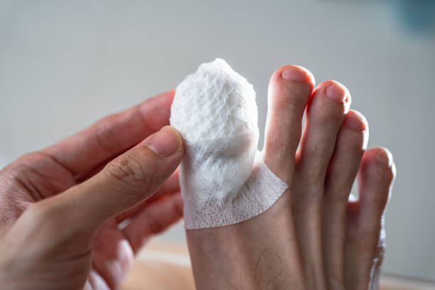 An injured toe with net bandage stock photo