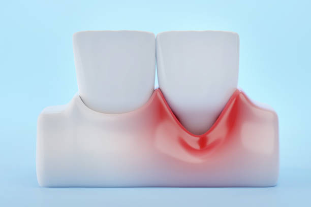 Gingival Recession Gingival Recession and front teeth on blue background 3D rendering receding gums stock pictures, royalty-free photos & images