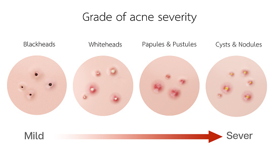 Acne type collection and severity concept. 3D rendering.